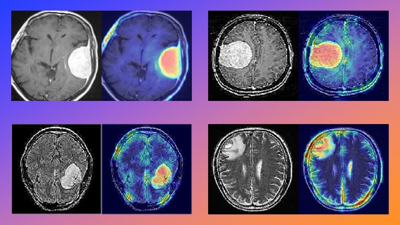 Aprendizaje Profundo para Imágenes Médicas: Detección de Tumores Cerebrales con Autoencoders